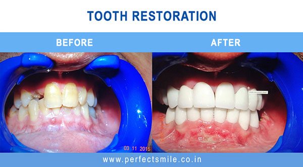 Tooth Restoration before and after