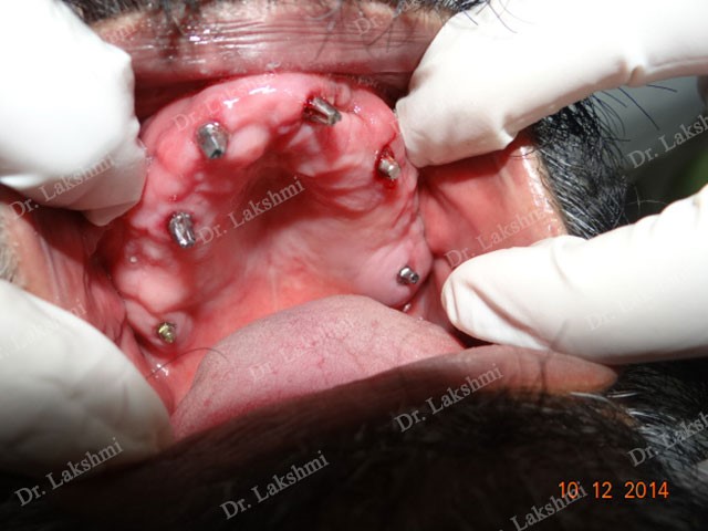 Basal Implants in Bangalore