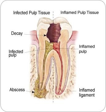 Dentist evaluating whether a root canal is needed