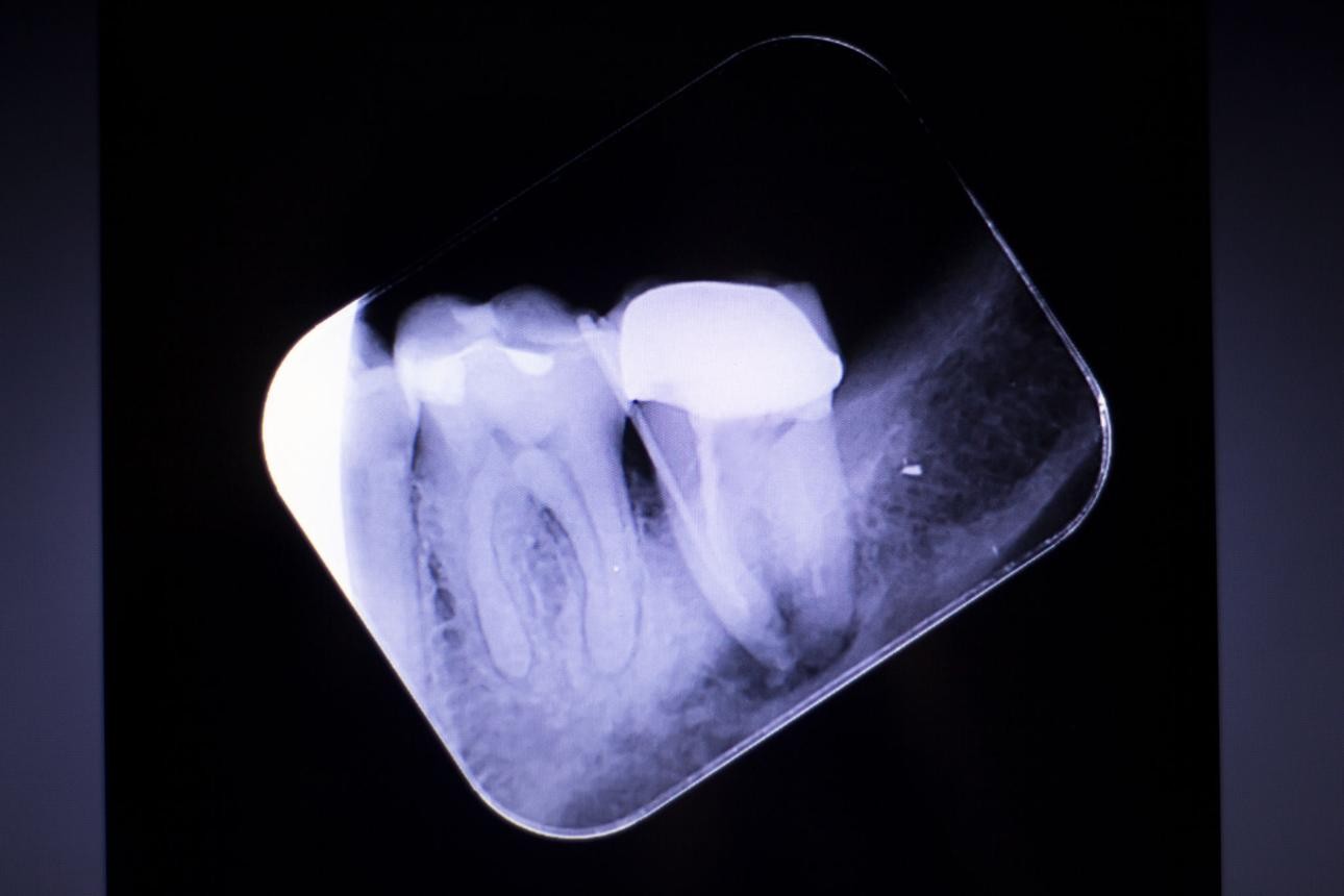 Dental X-ray used to decide root canal treatment