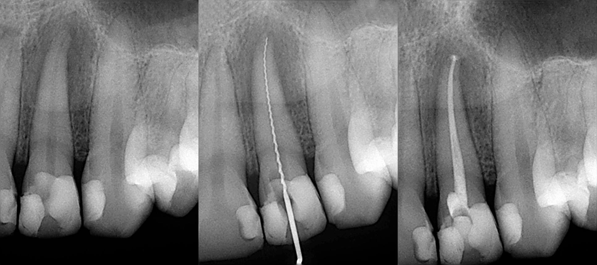 Dentist consultation for root canal treatment in Bangalore