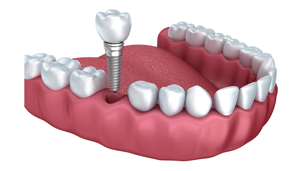 best dental implants in bangalore